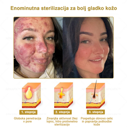 𝐀𝐏𝐊𝐀𝐏𝐊™ Zelo učinkovita večnamenska vlažilna krema za odstranjevanje bradavic