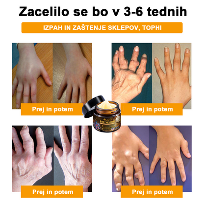 🔥 𝘈𝘦𝘵𝘩𝘦𝘳𝘪𝘴™ Krema za lajšanje artritisa s čebeljim strupom (posebej za starejše odrasle) 🦴– zadnji dan promocije: 70 % popusta 💪