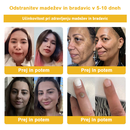 ✨🎁𝑭𝑹𝑶𝑷𝑼𝑵™ krema za odstranjevanje znamenj in madežev (85% popust zadnji dan dogodka)