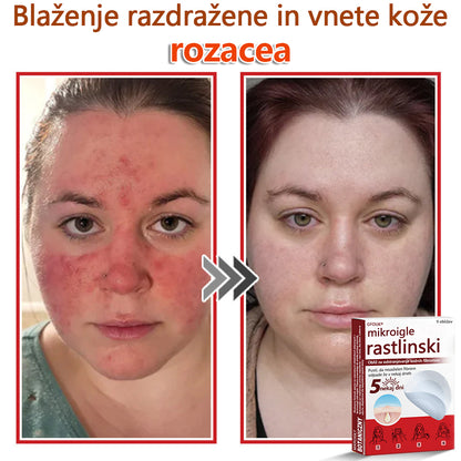 👨‍⚕️ GFOUK® MicroNeedle obliž za odstranjevanje kožnih izrastkov 🇪🇺 Skupno z EU smernicami za nego kože