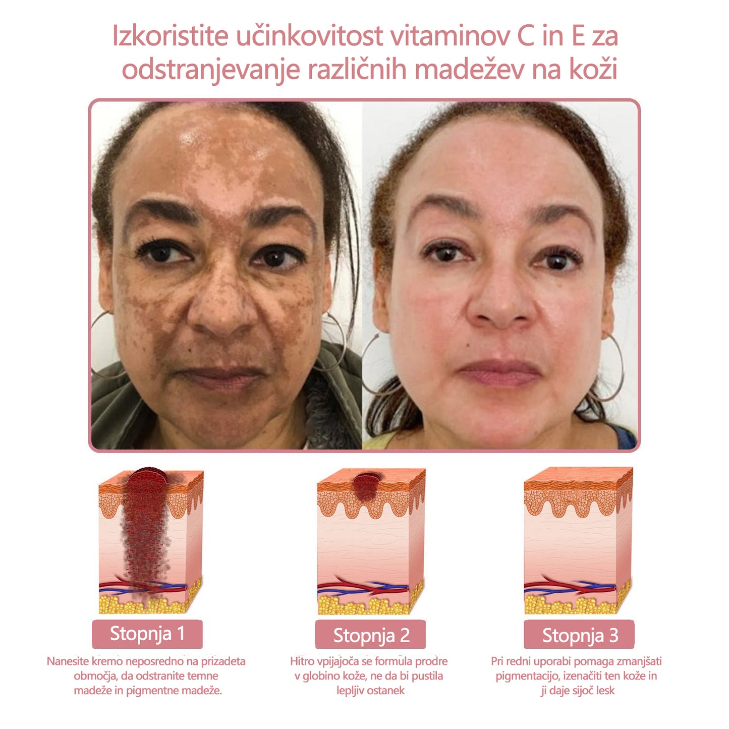 Koencim Q10 Collagen Jelly Skin Cream Odobreno Britansko združenje dermatologov (BAD) (pomaga pri aknah, bradavicah, rozacei, psoriazi, starostnih pegah, ekcemih in zmanjša videz strij)