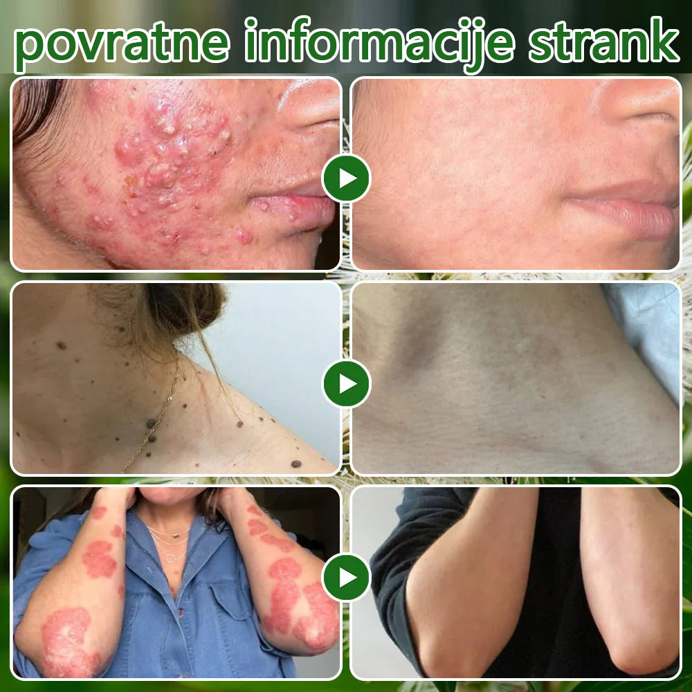 ✅ Certificirano s strani JAZMP 🌿 Zvoevo® Krema z oljem čajevca – Odpravlja nepravilnosti na koži, obnavlja poškodovano kožo, posvetli polt in nudi nego proti staranju 🌳