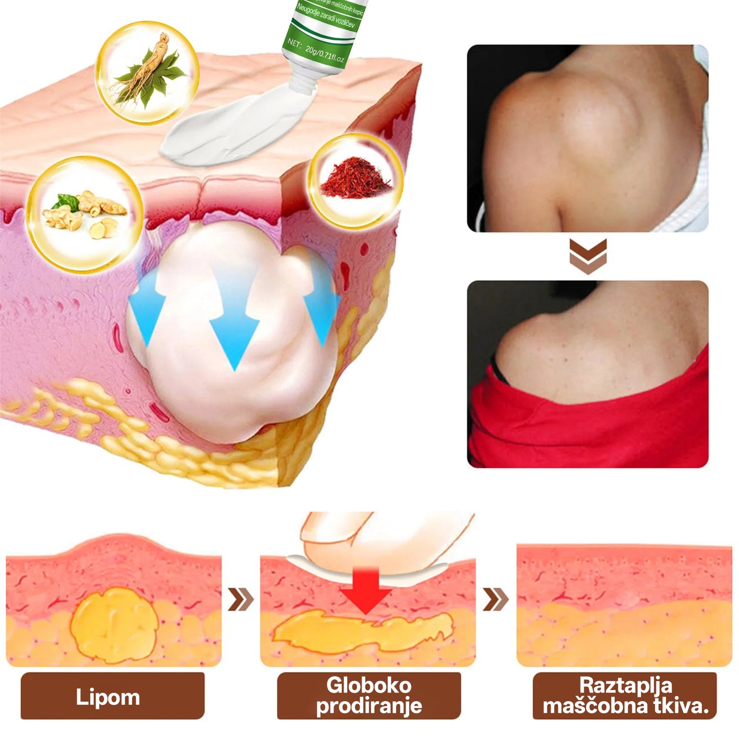 Cvreoz® KnotAway Pomirjevalno Mazilo – Pomirjevalno Mazilo za Naravno Zmanjšanje Lipomov🌿