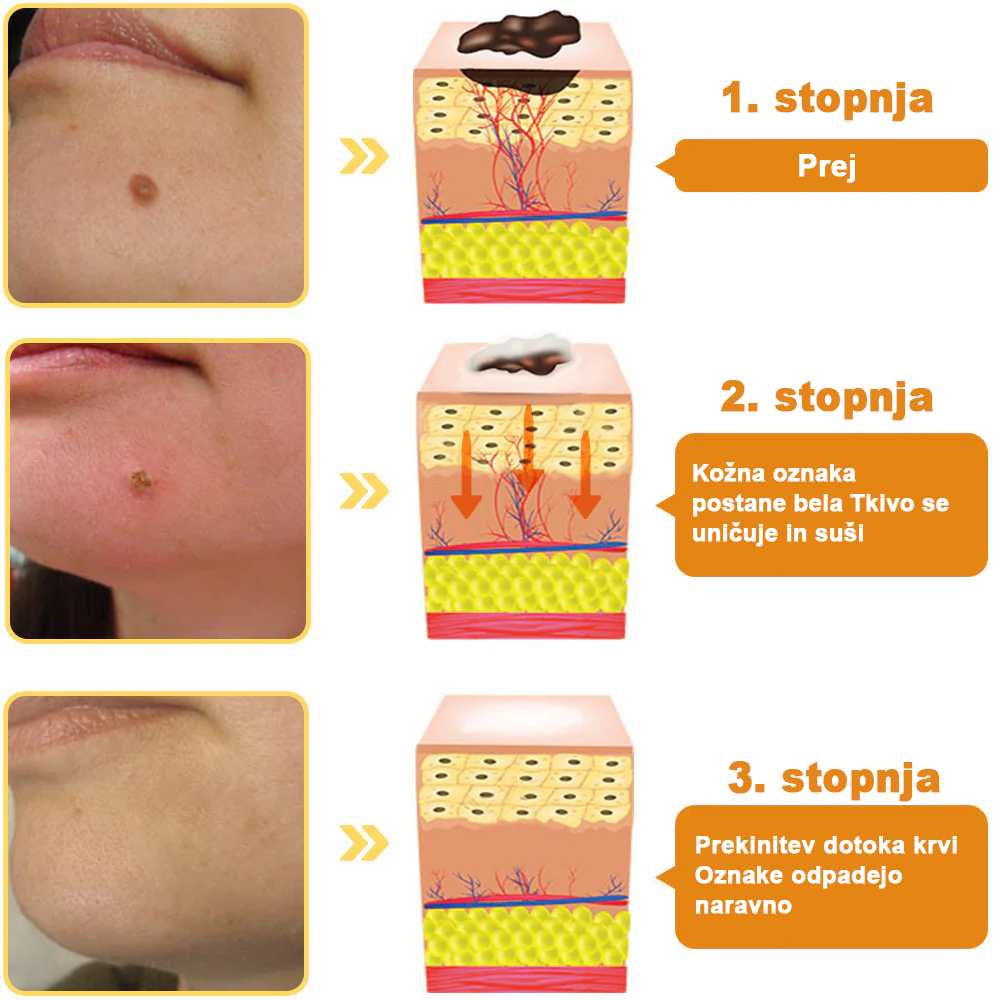 [🌟 gotovina ob dostavi (COD) 🌟] 𝐀𝐰𝐳𝐥𝐨𝐯𝐞™ Krema za zdravljenje madežev in bradavic s čebeljim strupom (priporočila 👨‍⚕AAD)