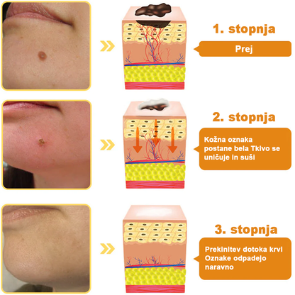 [🌟 gotovina ob dostavi (COD) 🌟] 𝐀𝐰𝐳𝐥𝐨𝐯𝐞™ Krema za zdravljenje madežev in bradavic s čebeljim strupom (priporočila 👨‍⚕AAD)