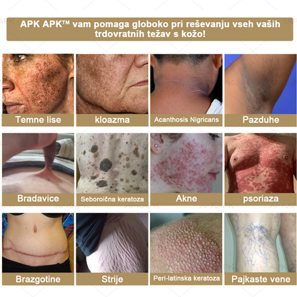 𝐀𝐏𝐊𝐀𝐏𝐊™ Zelo učinkovita večnamenska vlažilna krema za odstranjevanje bradavic