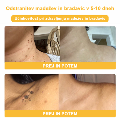𝑽𝒆𝒍𝒊𝒔𝒔𝒆™ 2024 (priporoča AAD), za odstranjevanje bradavic, aken in brazgotin. Zdravi različne kožne bolezni