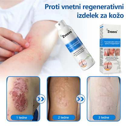✅ Uradna trgovina: Zvoevo® Magnezijev zeliščni sprej za luskavico ⚕️ EMA certificirano (lajša luskavico in ekcem, izboljšuje bakterijske okužbe na genitalnem področju, zdravi akne in bradavice, lajša bolečine v sklepih in nevropatske bolečine)