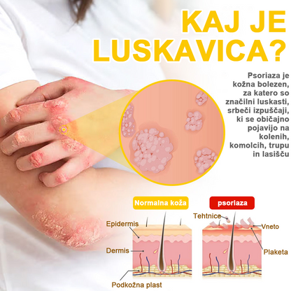 ✅flysmus™ zdravilna krema s čebeljim strupom🐝: Zdravljenje ekcemov, luskavice, aken, rozacee, glivičnih okužb, bradavic