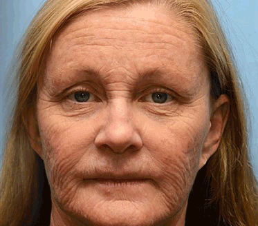 👩🏻‍⚕️🎁𝗥𝗲𝗴𝗮𝗶𝗻 𝘆𝗼𝘂𝘁𝗵𝗳𝘂𝗹 𝘀𝗸𝗶𝗻 𝗻𝗼𝘄𝗻🌌𝗦𝗧𝗗𝗘𝗜® 𝗕𝗢𝗧𝗢𝗫 & 𝗩𝗜𝗧𝗔𝗠𝗜𝗡 𝗔 𝗥𝗘𝗧𝗜𝗡𝗢𝗟 𝗜𝗡𝗝𝗘𝗞𝗖𝗜𝗝𝗔 𝗚𝘂𝗯𝗮𝗻𝗷𝗲𝗺 𝗗𝘃𝗶𝗴𝗼𝘃𝗮𝗻𝗷𝗲 𝗭𝗮𝘁𝗲𝘇𝗼𝘃𝗮𝗻𝗷𝗲 𝗦𝗺𝗲𝘁𝗮𝗻𝗮